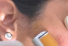 Atasi Jerawat Membandel: Strategi Komprehensif untuk Kulit Bersih dan Sehat