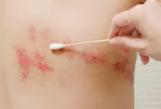 Jangan Salah Lagi! Kenali Beda Cacar Air dan Campak Demi Perlindungan Optimal