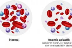 Penyakit Langka! Anemia Aplastik: Penyebab, Gejala, dan Cara Pencegahan