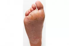 7 Penyebab Utama Kaki Pecah-Pecah, Kurangnya Kelembapan Membuat Kulit Menjadi Keras