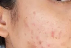 Remaja harus Tau, Ini Penyebab Jerawat