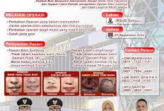 Layanan Kesehatan Gratis dari Pemkab Muba: Operasi Bibir Sumbing dan Skrining Kanker Serviks Berbasis AI