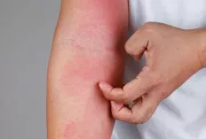 Kamu Harus Tahu, Penyebab Eksim dan Cara Mengatasinya