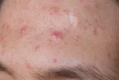 7 Tips Ampuh Menghilangkan Jerawat Membandel